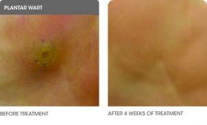 Cryotherapy to get rid of Warts, Skin Tags, Age Spots