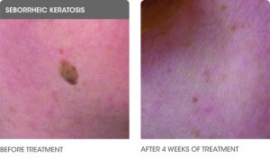 Cryotherapy to get rid of Warts, Skin Tags, Age Spots