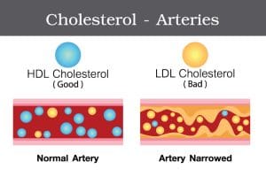 Can Cryotherapy help to reduce cholesterol?