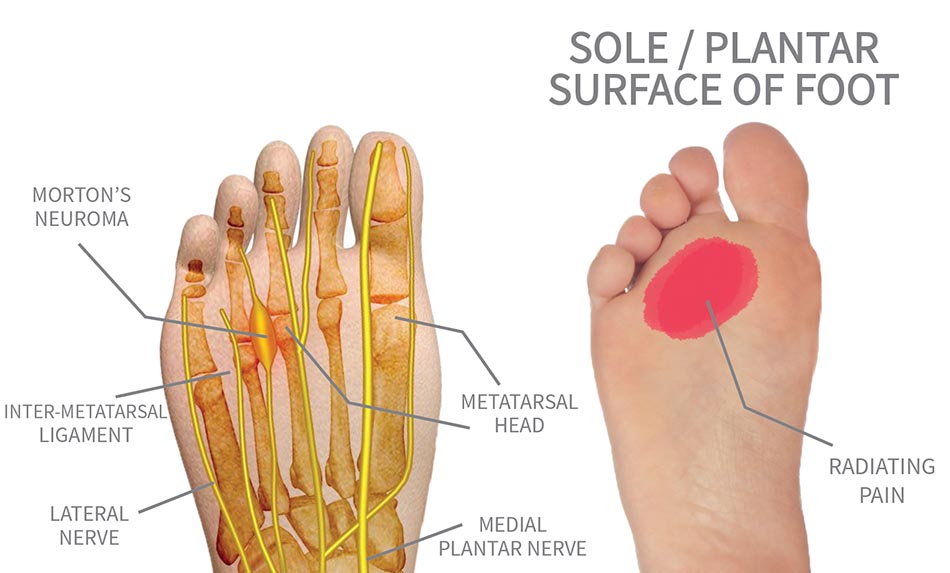 Is pain in the ball of your foot Mortons Neuroma?