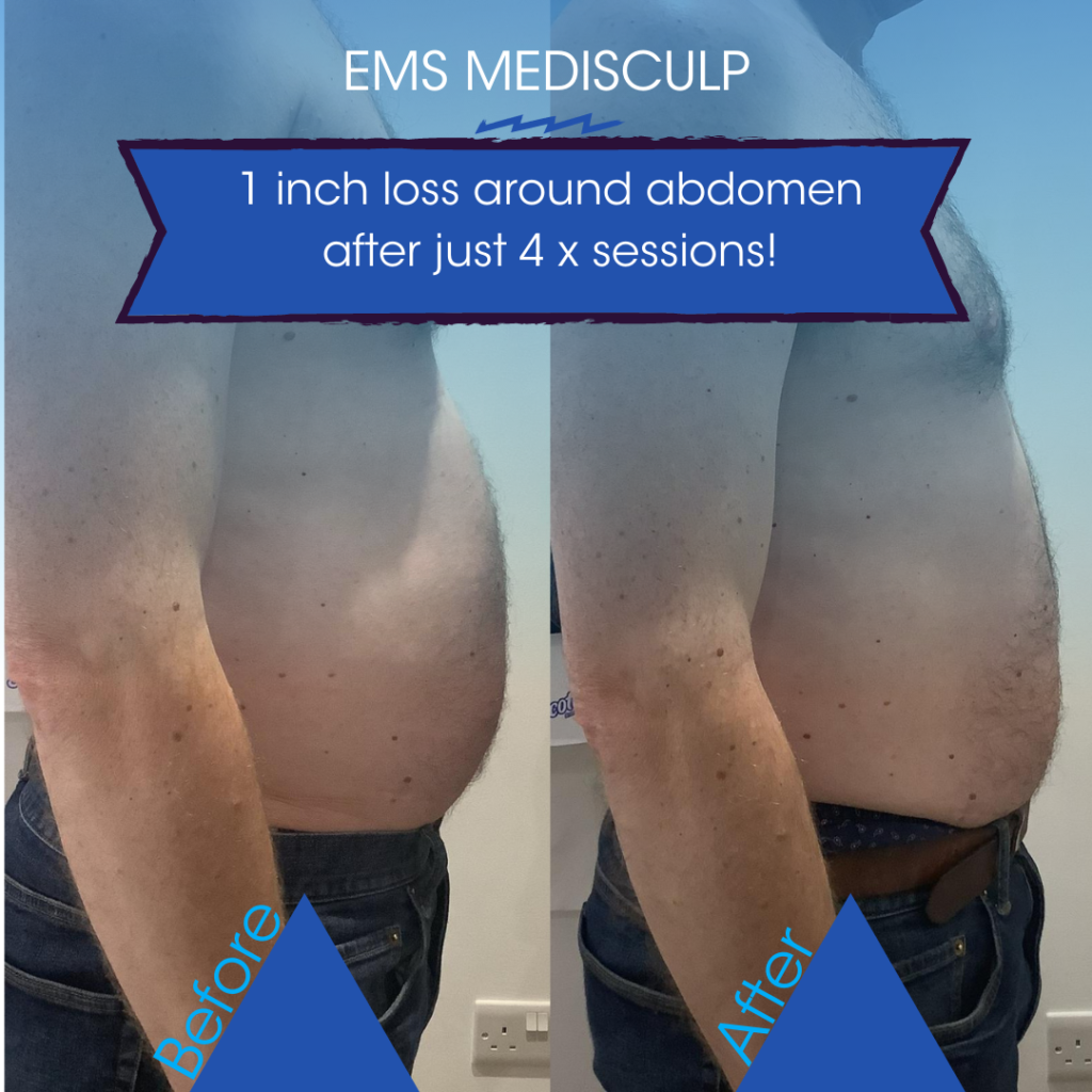 emsculpt ems medisculp inch loss before and after pictures at cryojuvenate sevenoaks kent