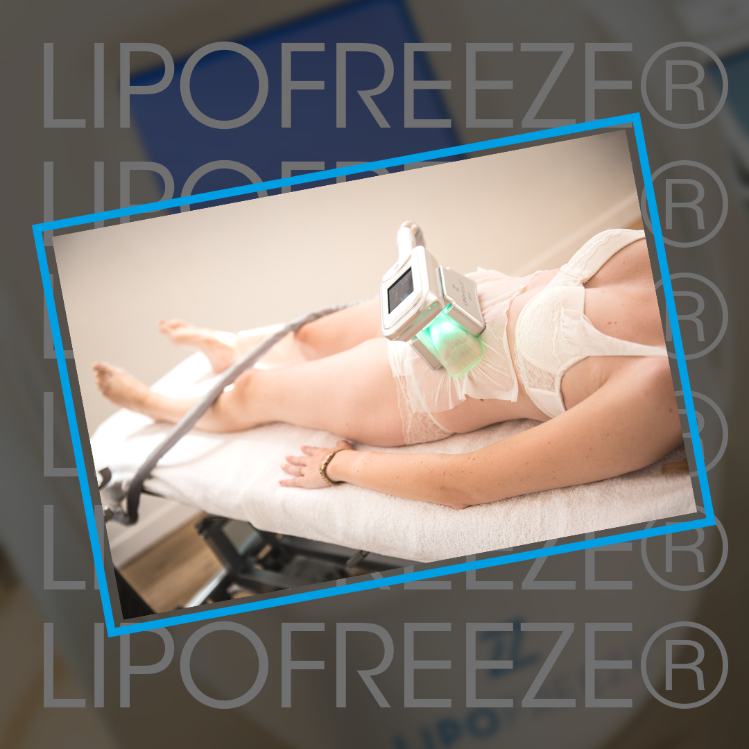 Fat Freezing using LIPOFREEZE on the abdomen at Cryojuvenate
