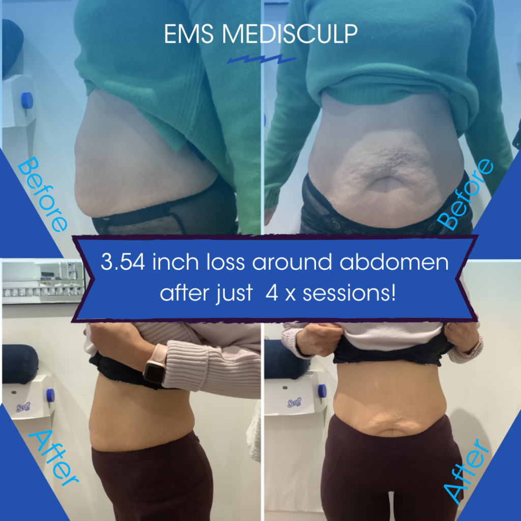 emsculpt before and after pictures at cryojuvenate sevenoaks kent