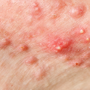 nodular melanoma skin cancer awareness at cryojuvenate