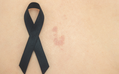 Nodular melanoma skin cancer – do you know what to look out for?
