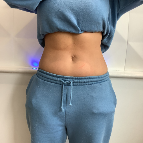 another example -after emsculpt, front facing view of abdomen after treatment