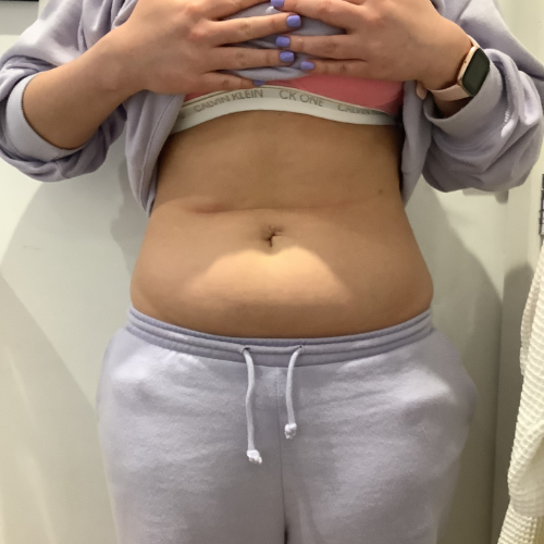 another example - before emsculpt, front facing view of abdomen before treatment