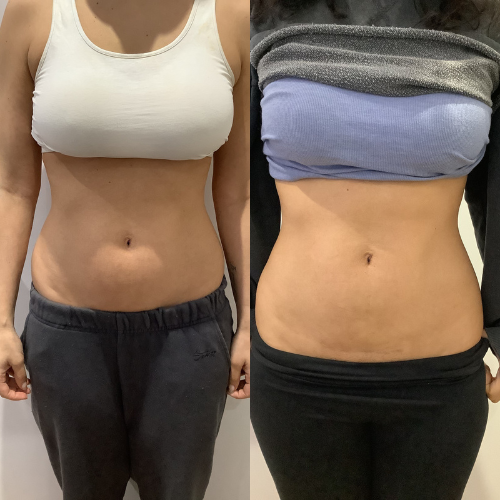 before and after emsculpt treatment on abdomen