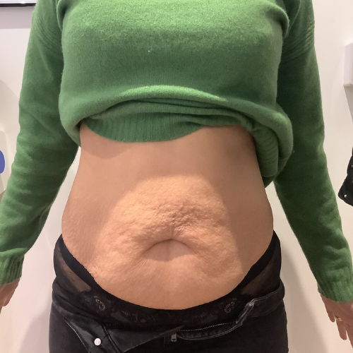 before emsculpt - female client with lots of excess fat and skin on abdomen