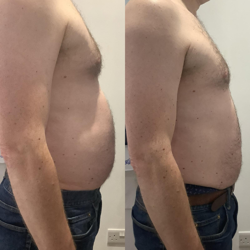 before and after emsculpt treatment on abdomen - male client