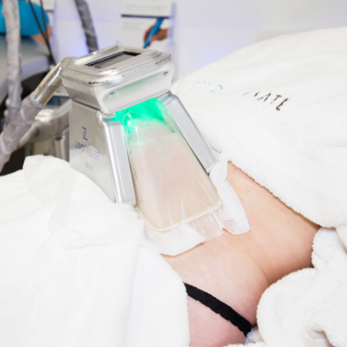 lipofreeze cryolipolysis