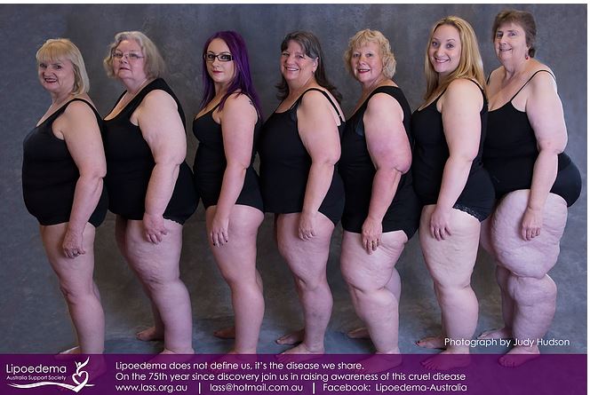 LIPOEDEMA! Which Compression Garments are recommended for
