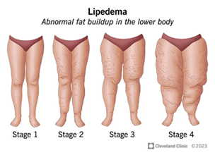 stages of lipoedema