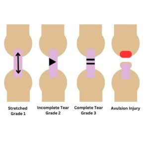 acl knee injury - types of knee injury
