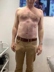 results of fat freezing 1