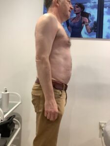 results of fat freezing 2