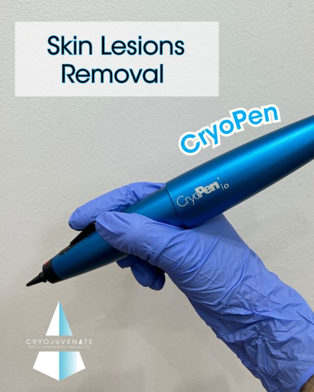 Have you been meaning to get that skin tag, wart or age spot looked at? 👀 

Our CryoPen® treatment is one of those services that people often wish they'd booked sooner.

Using an ultra-cold jet of nitrous oxide, CryoPen® precisely targets unwanted benign skin lesions, making treatment quick, accurate and minimally invasive. ✨

It can be used to treat:

💙 Skin tags
 💙 Verrucas
 💙 Warts
 💙 Age spots
 💙 Cherry angiomas
 💙 And many other common benign skin lesions

If you're unsure whether CryoPen® is suitable for you, pop in for a consultation and we'll happily talk you through your options - no pressure, just honest advice. 😊

Link in bio.

#Cryojuvenate #CryoPen #SkinHealth #Sevenoaks #Wellness