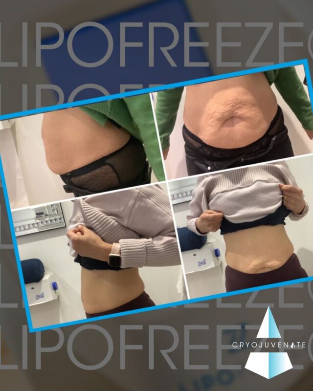 We've all got those areas that seem completely immune to healthy eating and exercise. 🙈

That's exactly why treatments like LipoFreeze® 360 exist.

Using controlled cooling, the treatment targets stubborn fat cells without surgery or downtime, making it a popular option for people looking to fine-tune areas that simply won't budge.

Every consultation is tailored because no two bodies or goals, are the same. 💙

Curious whether it's the right treatment for you?

Come and have a chat with us. No pressure, just honest advice.

More information is waiting via the link in our bio. 

#Cryojuvenate #LipoFreeze360 #BodyContouring #Sevenoaks #Wellness